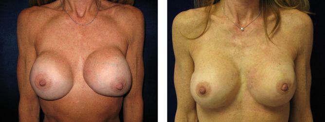 42 Year Old Female - Breast Revision - bodybyZ