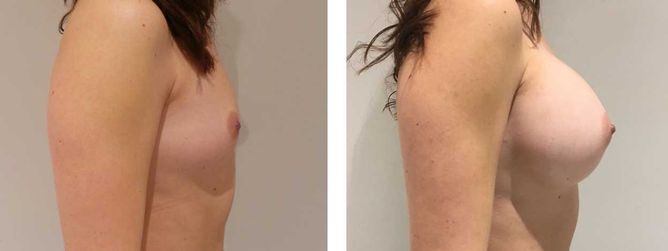 28 Year Old Female - Breast Augmentation