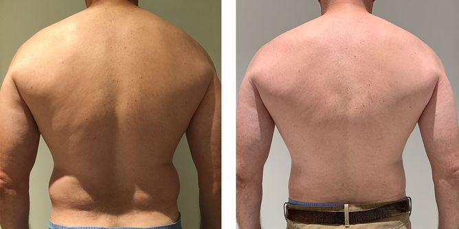 46 Year Old Male - Liposuction - bodybyZ
