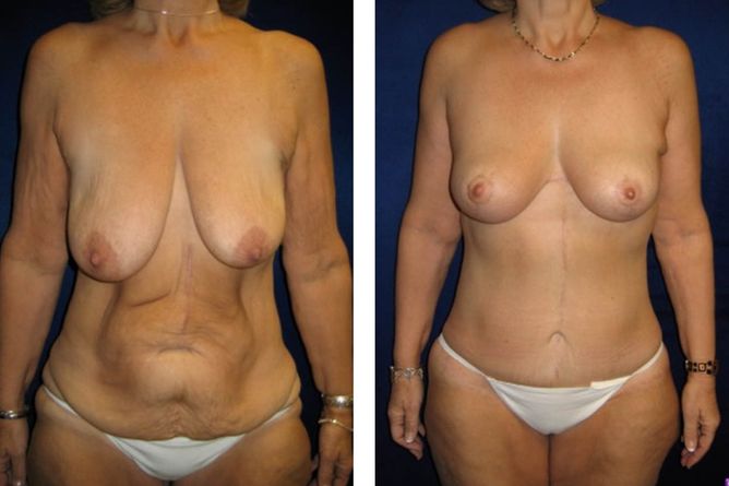 Major Weight Loss Surgery - bodybyZ