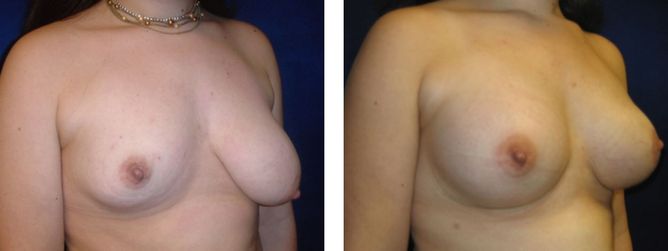 17 Year Old Female - Breast Revision - bodybyZ