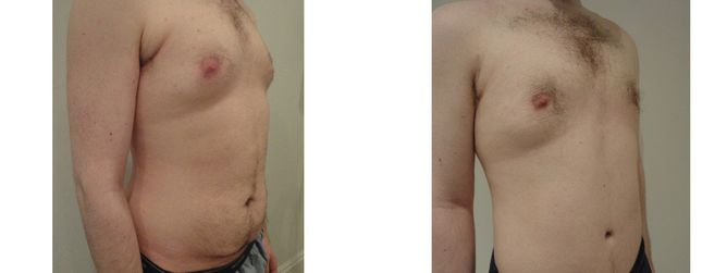 27 Year Old Male - Tummy Tuck Surgery
