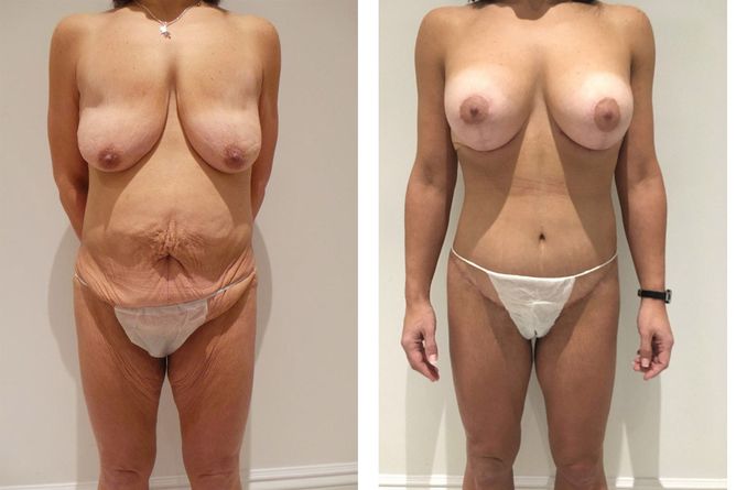 45 Year Old Female - Major Weight Loss Surgery - bodybyZ