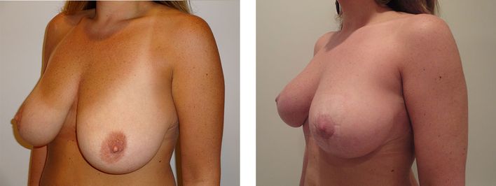 40 Year Old Female - Breast Lift - bodybyZ
