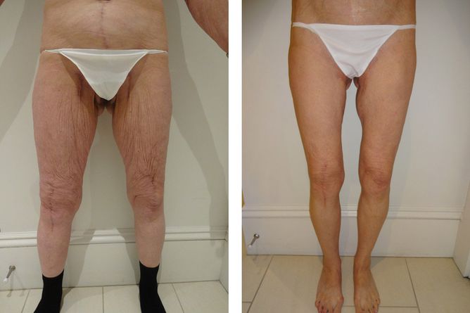 50 Year Old Female - Major Weight Loss Surgery - bodybyZ
