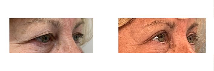 57 Year Old Female - Eyelid Surgery - bodybyZ