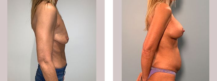 51 Year Old Female - Breast Lift - bodybyZ