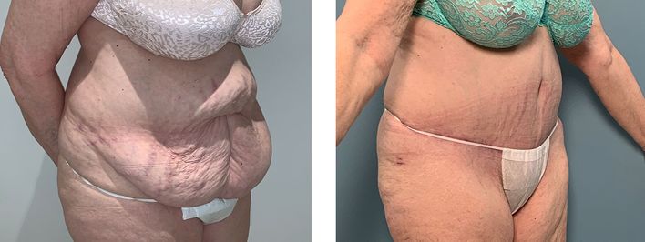 73 Year Old Female - Tummy Tuck Surgery