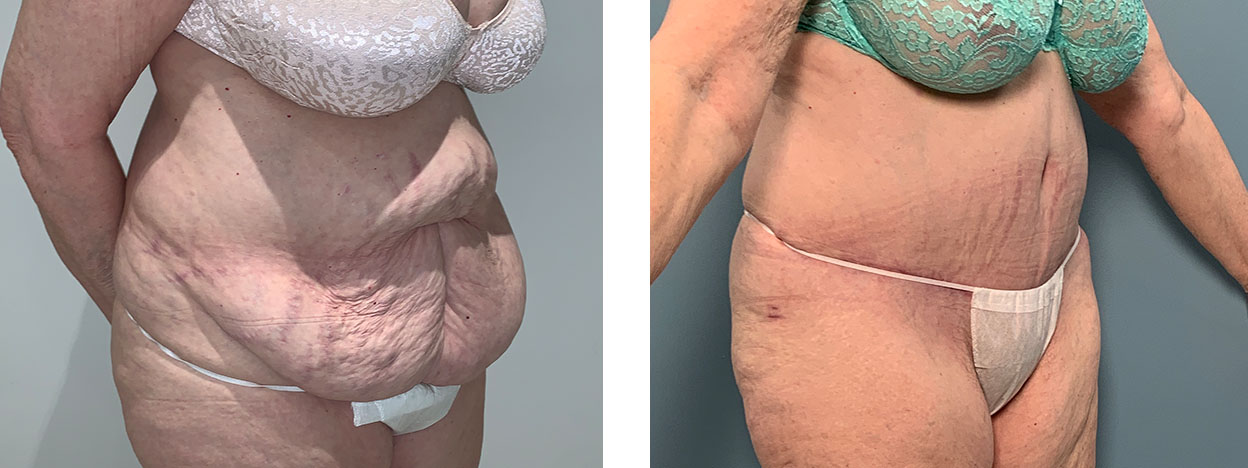 73 Year Old Female - Tummy Tuck Surgery