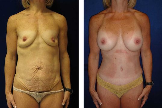 45 Year Old Mother - TABA - bodybyZ