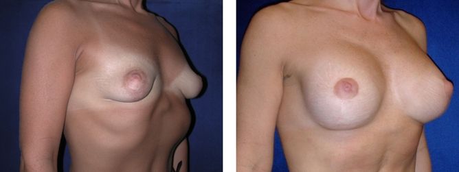 40 Year Old Female - Breast Revision - bodybyZ
