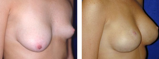 Breast Revision - bodybyZ