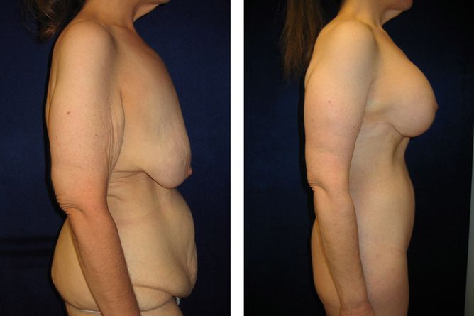50 Year Old Female - Major Weight Loss Surgery - bodybyZ