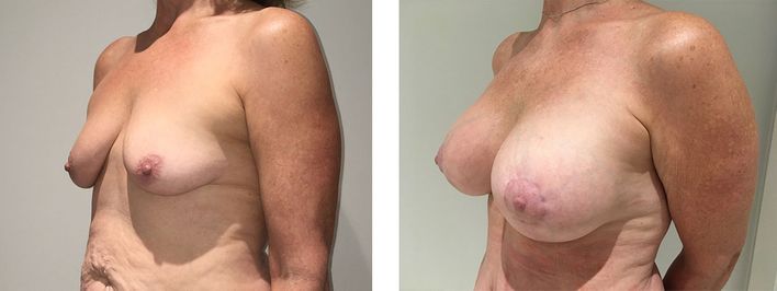 54 Year Old Female - Breast Lift - bodybyZ