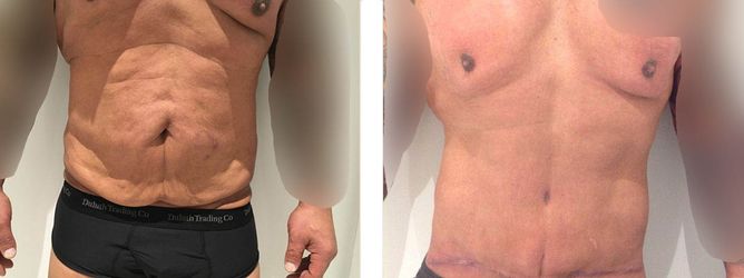 40 Year Old Male - Tummy Tuck Surgery