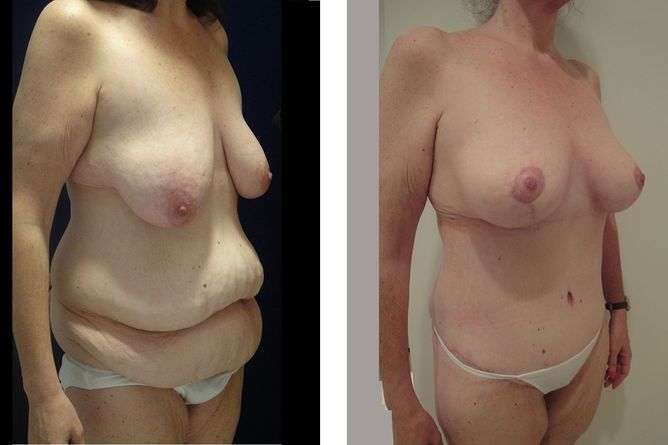 43 Year Old Female - Major Weight Loss Surgery - bodybyZ