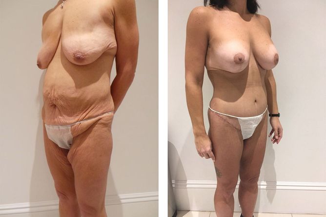 45 Year Old Female - Major Weight Loss Surgery - bodybyZ