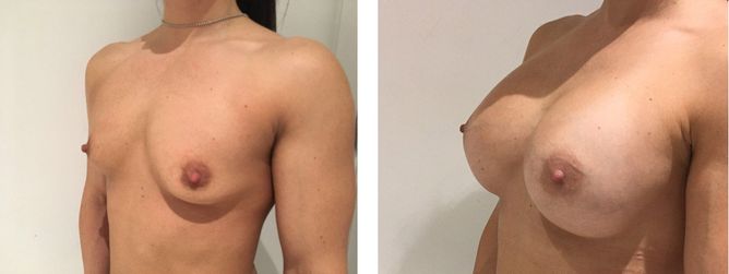 30 Year Old Female - Breast Augmentation