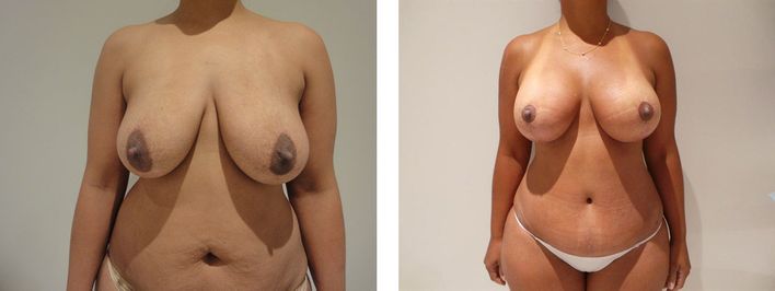 40 Year Old Female - Breast Lift - bodybyZ