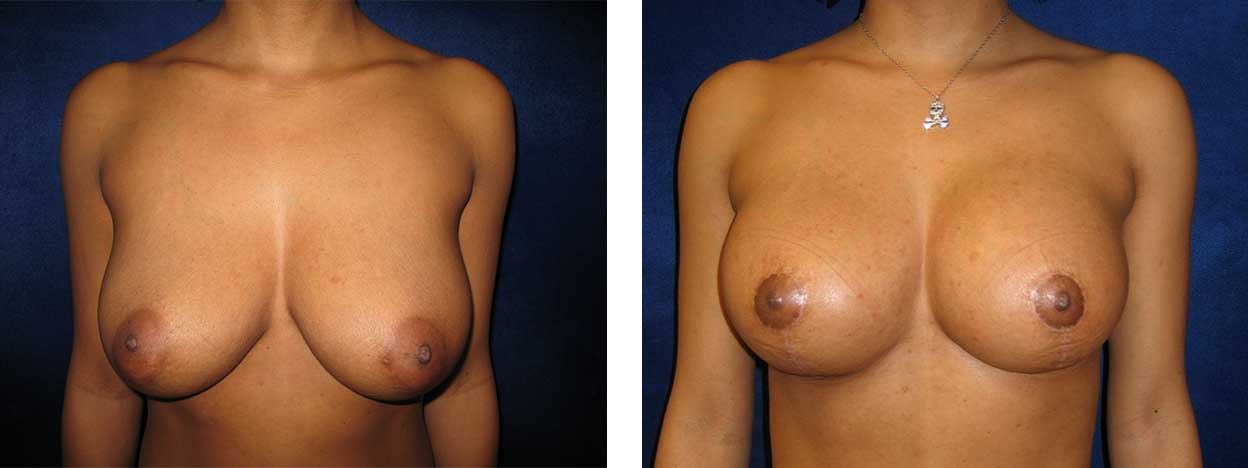 35 Year Old Female - Breast Lift - bodybyZ