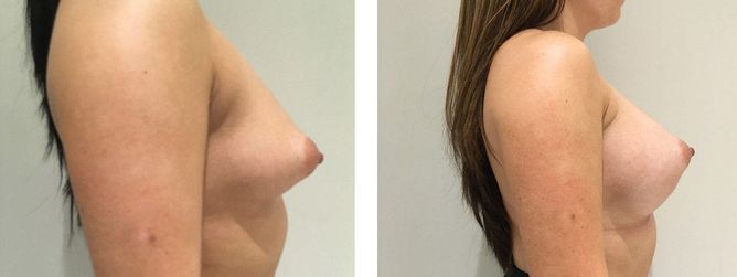 24 Year Old Female - Breast Augmentation