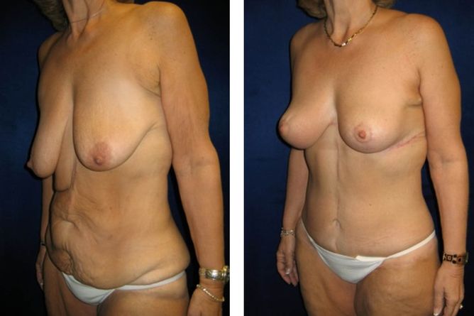 Major Weight Loss Surgery - bodybyZ