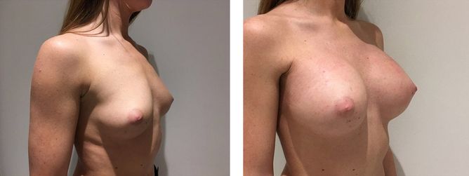 26 Year Old Female - Breast Augmentation