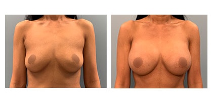 Breast Augmentation Surgery, breast implants
