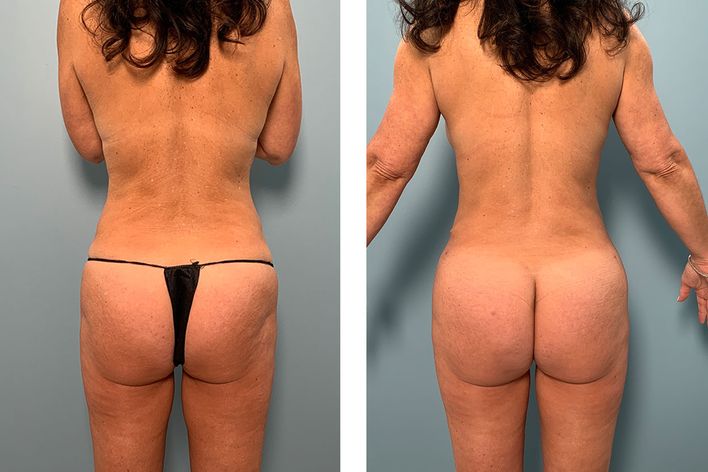 Brazilian Butt Lift Liposuction - Providence, RI