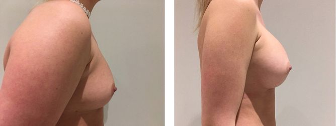 25 Year Old Female - Breast Augmentation