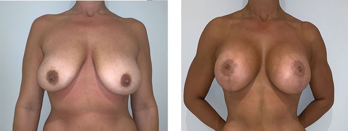 41 Year Old Female - Breast Lift - bodybyZ