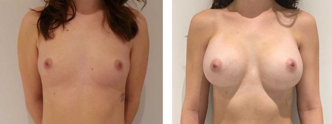 28 Year Old Female - Breast Augmentation
