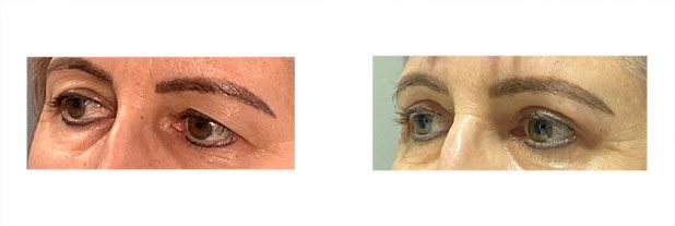 Upper Eyelid Surgery