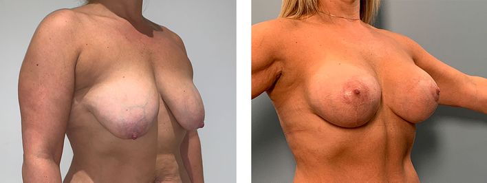 45 Year Old Female - Breast Revision - bodybyZ