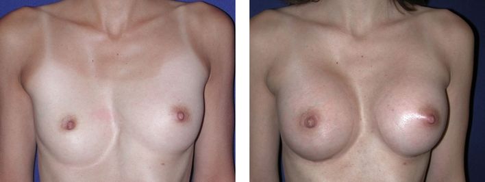 21 Year Old Female - Breast Revision - bodybyZ