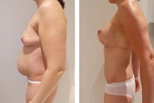 40 Year Old Female - TABA - bodybyZ