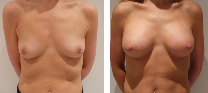 35 Year Old Female - Breast Augmentation