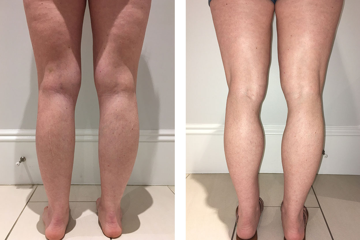 40 Year Old Female - Liposuction - bodybyZ
