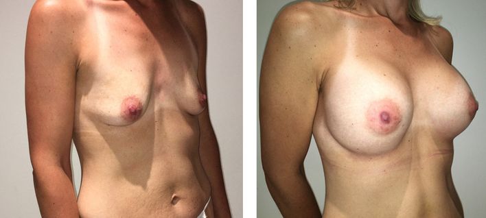 28 Year Old Female - Breast Augmentation