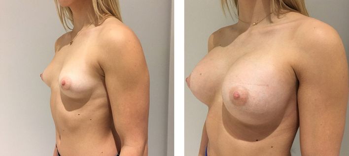 19 Year Old Female - Breast Augmentation