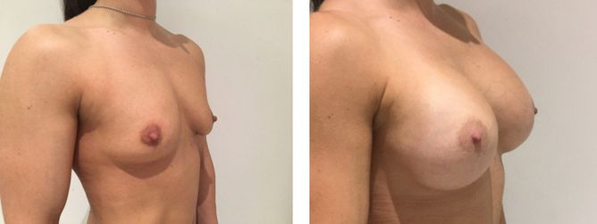 30 Year Old Female - Breast Augmentation