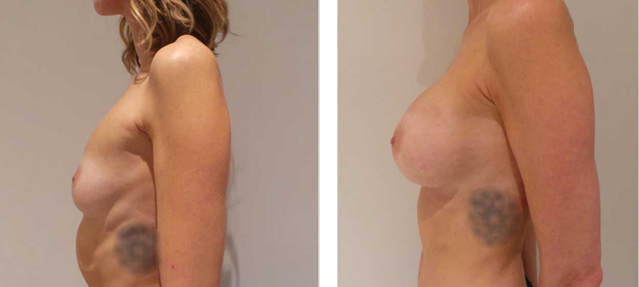 33 Year Old Female - Breast Augmentation