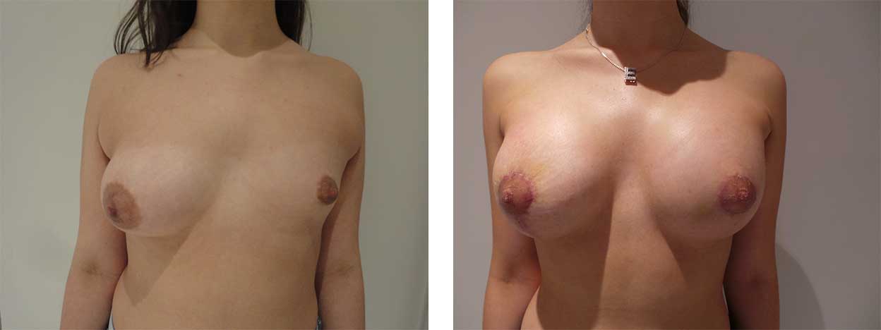 20 Year Old Female - Breast Lift - bodybyZ