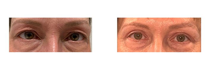 55 Year Old Female - Eyelid Surgery - bodybyZ