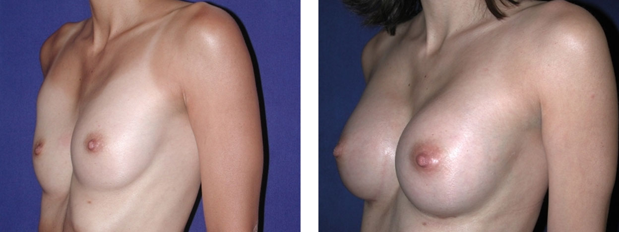 21 Year Old Female - Breast Revision - bodybyZ