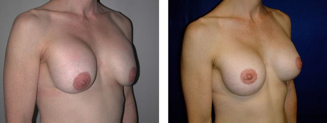 42 Year Old Female - Breast Revision - bodybyZ