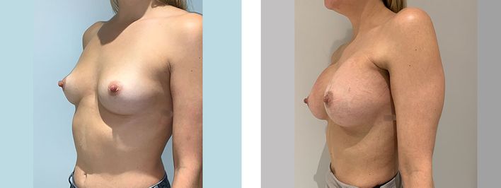 34 Year Old Female - Transaxilary Breast Augmentation