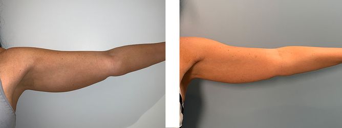 40 Year Old Female - Liposuction - bodybyZ
