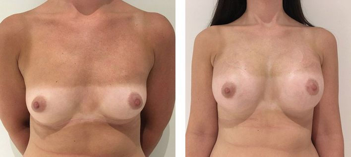 30 Year Old Female - Breast Augmentation
