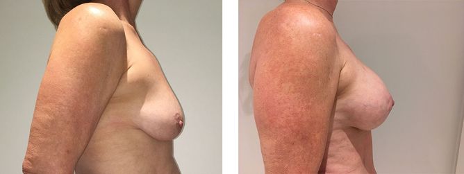 54 Year Old Female - Breast Lift - bodybyZ